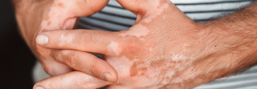 El vitiligo es una enfermedad que nadie para, aún no existe una cura.